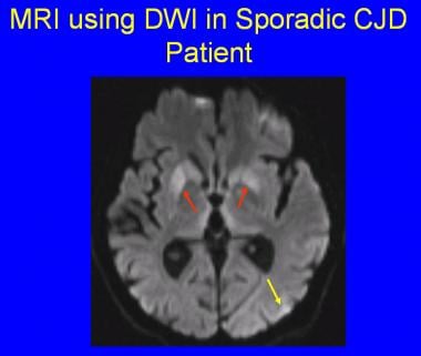 Shows characteristic signal changes of an MRI take