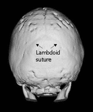Posterior view of 3-dimensional cranial CT demonst