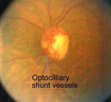 Fundus picture of a well-compensated, old central 