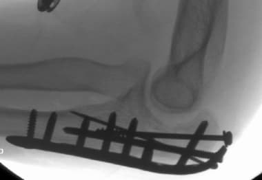 Plate fixation of comminuted olecranon fracture. 