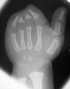 Radiograph of left hand of 1.5-year-old patient wi