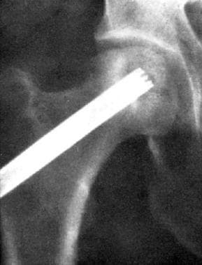 Osteonecrosis, hip. Anteroposterior radiograph cor