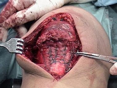 Patellar tendon rupture. The repair is now complet