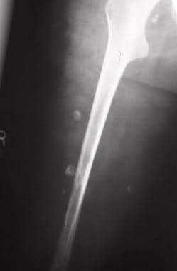 Radiograph showing phleboliths in an intramuscular