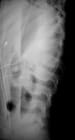 Spinal Dislocations