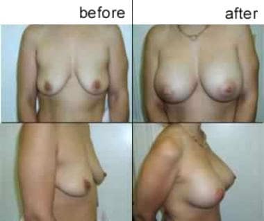 Breast augmentation, subglandular. This patient wa