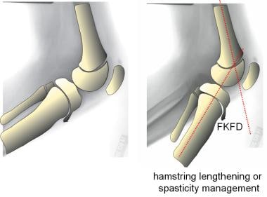 Pediatric Fixed Knee Flexion Deformities Clinical Presentation