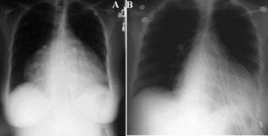 Chest radiographs revealing markedly enlarged card