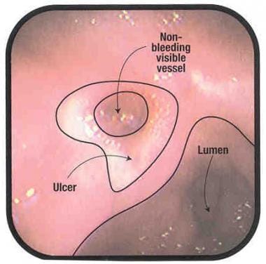 Upper gastrointestinal bleeding (UGIB). Diagram of