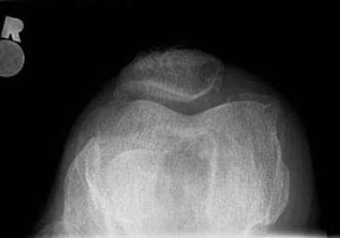 mi a patella arthritis ízületi gyulladás ízületi gyulladás hogyan kezelhető