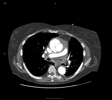 Patient with an ascending type A aortic dissection
