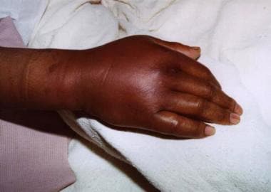Swelling seen in cellulitis involving the hand. In