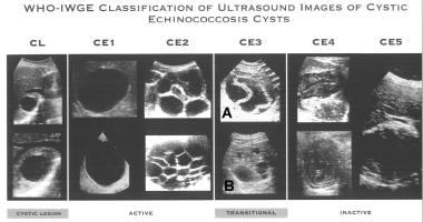 Echinococcosis Hydatid Cyst: Background, Pathophysiology, Epidemiology