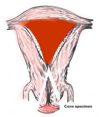 Conization site as related to uterine anatomy. 