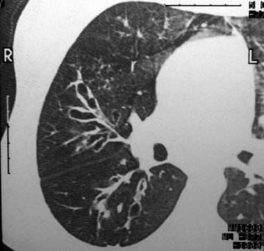 This CT scan depicts areas of both cystic bronchie