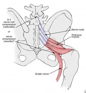 Nerve irritation in the herniated disk occurs at t