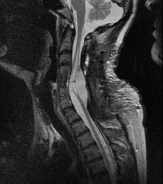 t2加权磁共振成像(MRI)扫描