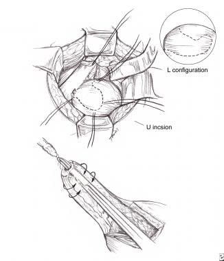 Boari flap procedure in ureteral trauma. 