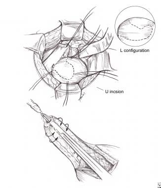 Ureteral Trauma Treatment & Management: Surgical Therapy, Complications ...