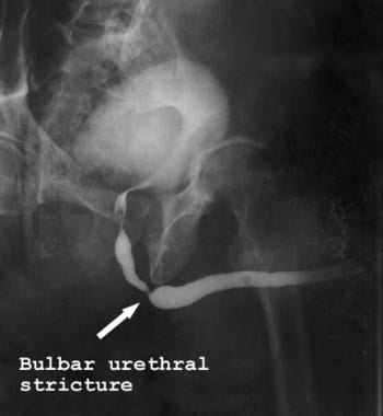 Retrograde urethrogram demonstrating bulbar urethr