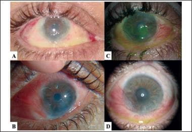 Photographs of right eye after airbag-related alka