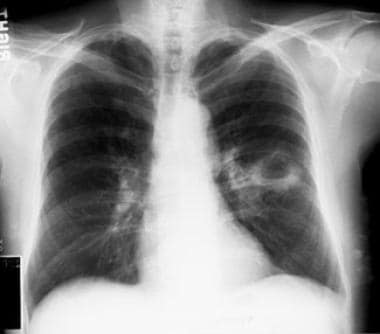 Empyema and Abscess Pneumonia. A 54-year-old patie