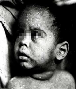 Small child with pustular lesions of variola. Phot