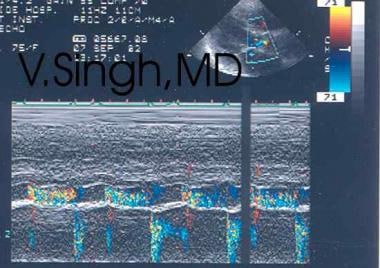 Aortic regurgitation. Color Doppler echocardiogram