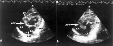 Subcostal 4-chamber 2-dimensional echocardiographi