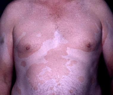 Some patients present with extensive tinea versico