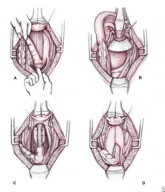 Pediatric Rectal Prolapse Treatment & Management: Approach Considerations,  Manual Reduction, Conservative Management