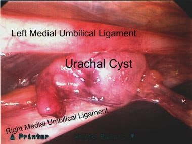 Laparoscopic removal of urachal cyst. View is from