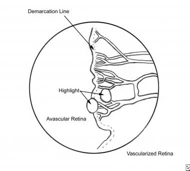 Retinopathy of Prematurity. Stage I retinopathy of