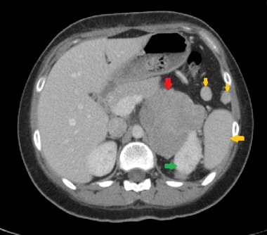This axial CT shows a large left adrenal carcinoma