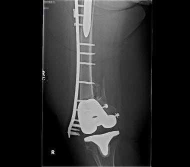 Failed periprosthetic repair (total hip above, tot