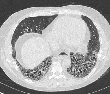 interstitial lung disease honeycombing