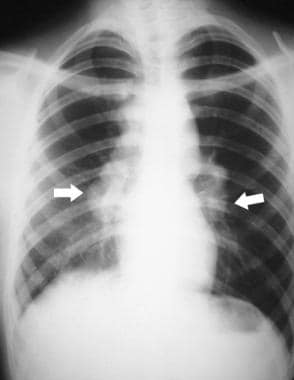 Dermatologic Manifestations of Pulmonary Disease: Overview, Cyanosis ...