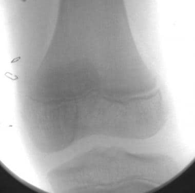 Growth plate (physeal) fractures. Resolution of pa