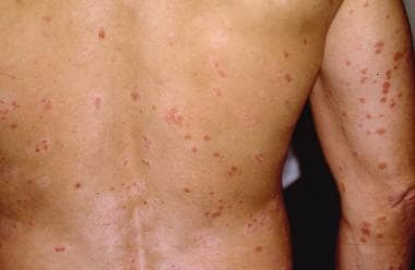 how long does guttate psoriasis last)