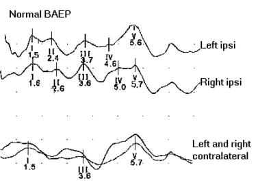 Normal brainstem auditory evoked potentials (BAEP)