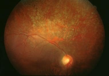 Chorioretinitis of ocular syphilis. 