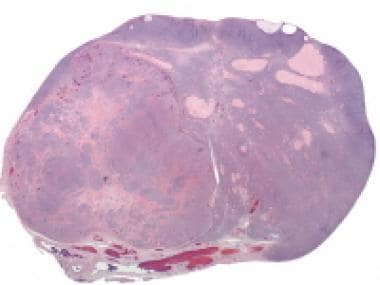 Leydig cell tumor (hematoxylin & eosin [H&E], x5).