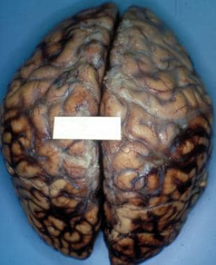 Brain specimen from a 32-year-old man who was the 