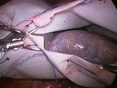Laparoscopic splenectomy. Placing spleen in retrie