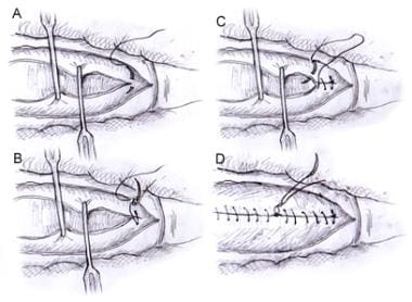 Incision Pfannenstiel Closure Abdominal Wound Pelvic Techniques Glowm ...