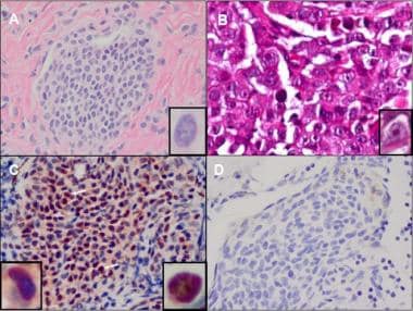 Sentinel Lymph Node Biopsy in Melanoma Pathology. 