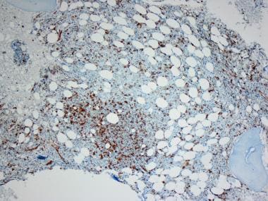 CD34 immunohistochemical stain of case of rmyelody
