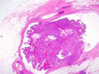 intraductal papilloma of salivary glands