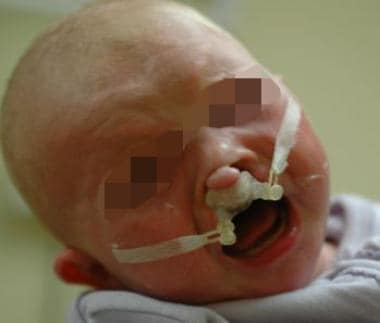 The same child being treated with a nasoalveolar m
