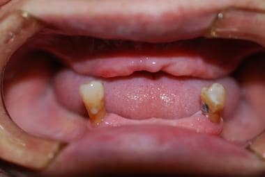 edentulous ridges classification